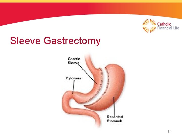 Sleeve Gastrectomy 81 