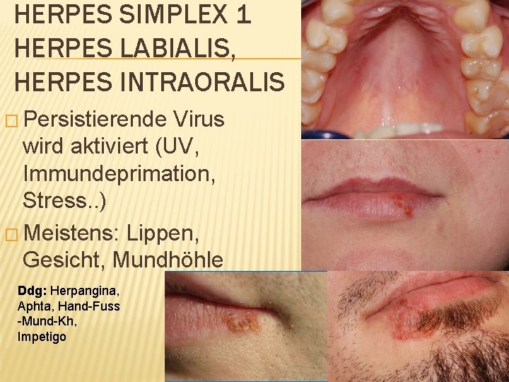 HERPES SIMPLEX 1 HERPES LABIALIS, HERPES INTRAORALIS � Persistierende Virus wird aktiviert (UV, Immundeprimation,