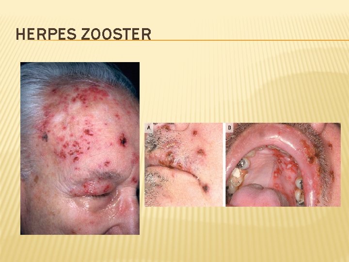 HERPES ZOOSTER 