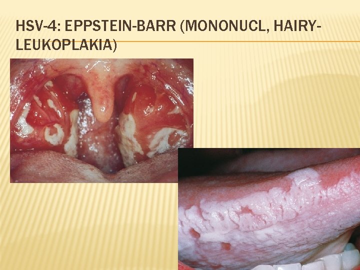 HSV-4: EPPSTEIN-BARR (MONONUCL, HAIRYLEUKOPLAKIA) 