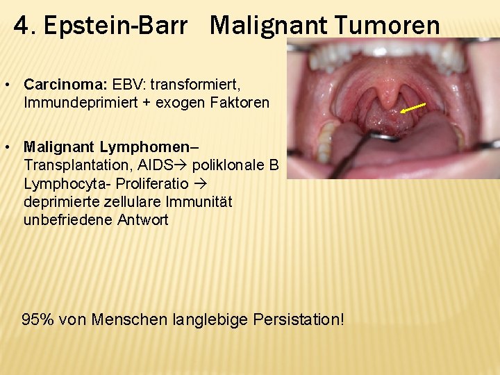 4. Epstein-Barr Malignant Tumoren • Carcinoma: EBV: transformiert, Immundeprimiert + exogen Faktoren • Malignant
