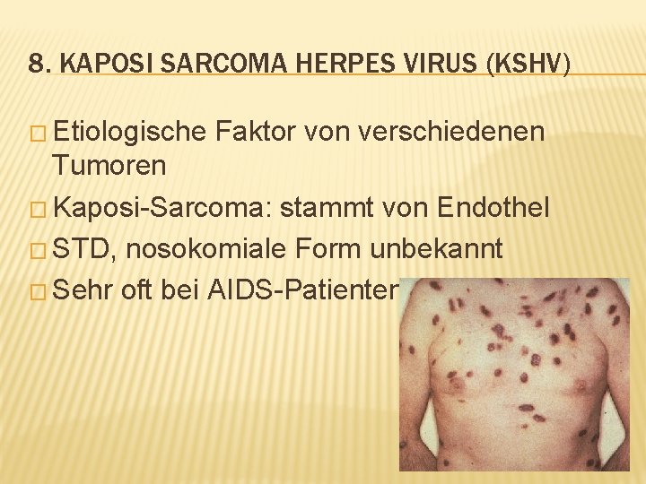 8. KAPOSI SARCOMA HERPES VIRUS (KSHV) � Etiologische Faktor von verschiedenen Tumoren � Kaposi-Sarcoma: