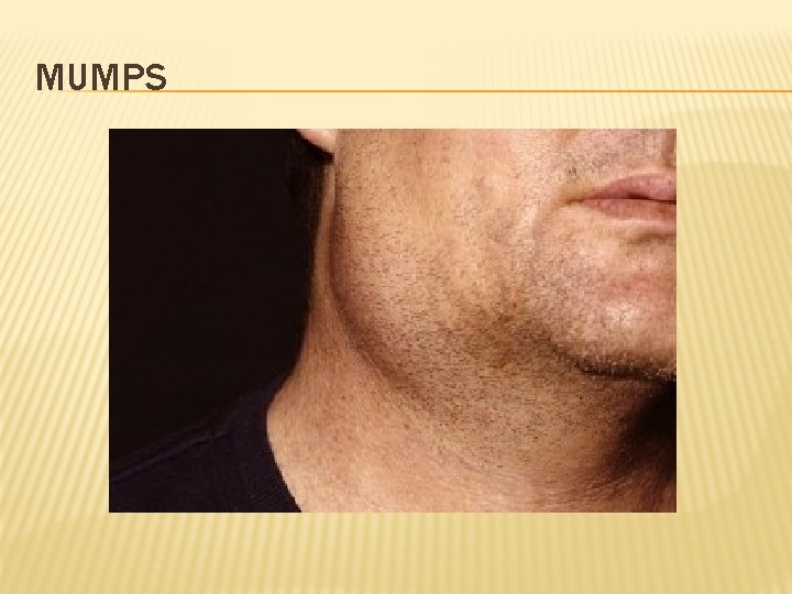 MUMPS 