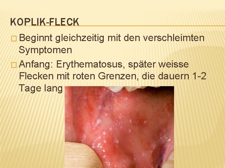 KOPLIK-FLECK � Beginnt gleichzeitig mit den verschleimten Symptomen � Anfang: Erythematosus, später weisse Flecken