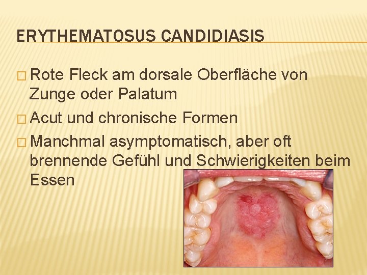 ERYTHEMATOSUS CANDIDIASIS � Rote Fleck am dorsale Oberfläche von Zunge oder Palatum � Acut