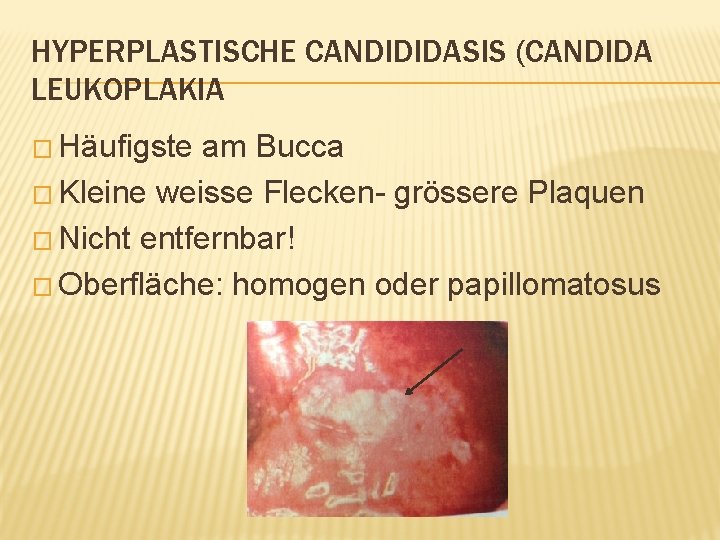 HYPERPLASTISCHE CANDIDIDASIS (CANDIDA LEUKOPLAKIA � Häufigste am Bucca � Kleine weisse Flecken- grössere Plaquen