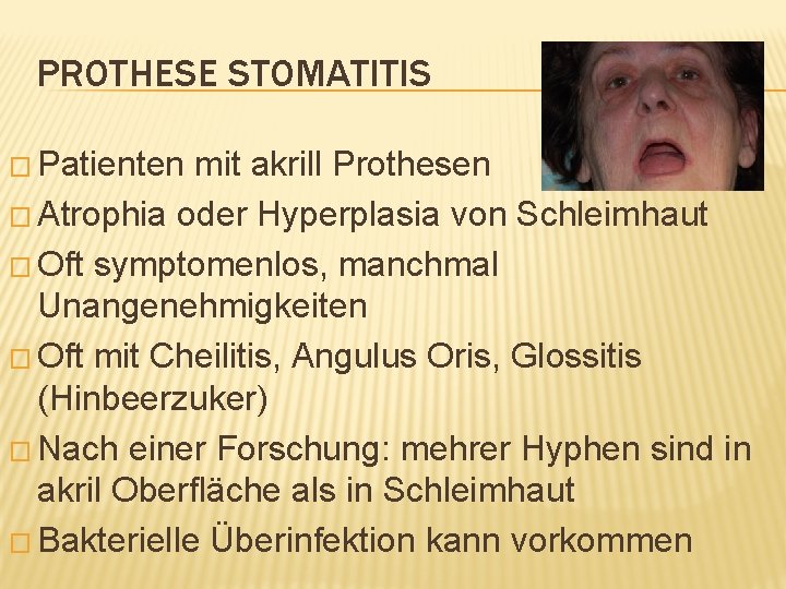 PROTHESE STOMATITIS � Patienten mit akrill Prothesen � Atrophia oder Hyperplasia von Schleimhaut �