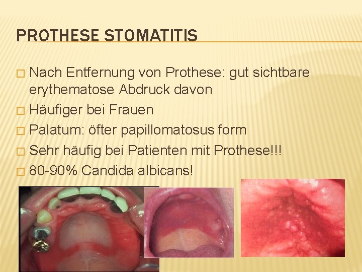 PROTHESE STOMATITIS Nach Entfernung von Prothese: gut sichtbare erythematose Abdruck davon � Häufiger bei