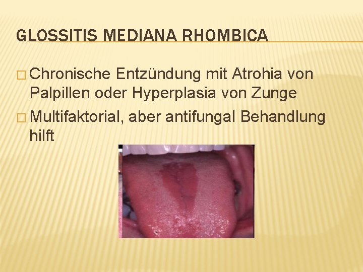 GLOSSITIS MEDIANA RHOMBICA � Chronische Entzündung mit Atrohia von Palpillen oder Hyperplasia von Zunge
