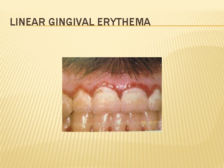 LINEAR GINGIVAL ERYTHEMA 