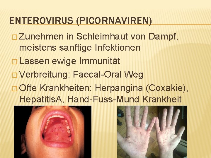 ENTEROVIRUS (PICORNAVIREN) � Zunehmen in Schleimhaut von Dampf, meistens sanftige Infektionen � Lassen ewige