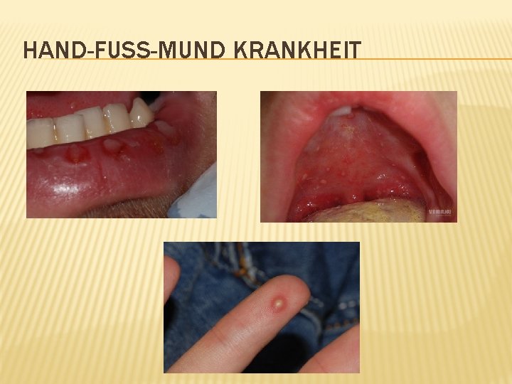 HAND-FUSS-MUND KRANKHEIT 