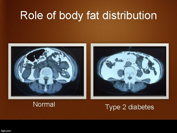 Role of body fat distribution Normal Type 2 diabetes 