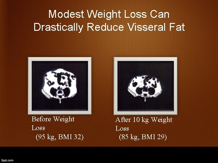 Modest Weight Loss Can Drastically Reduce Visseral Fat Before Weight Loss (95 kg, BMI