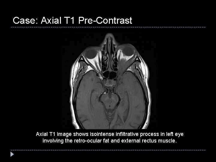Case: Axial T 1 Pre-Contrast Axial T 1 image shows isointense infiltrative process in