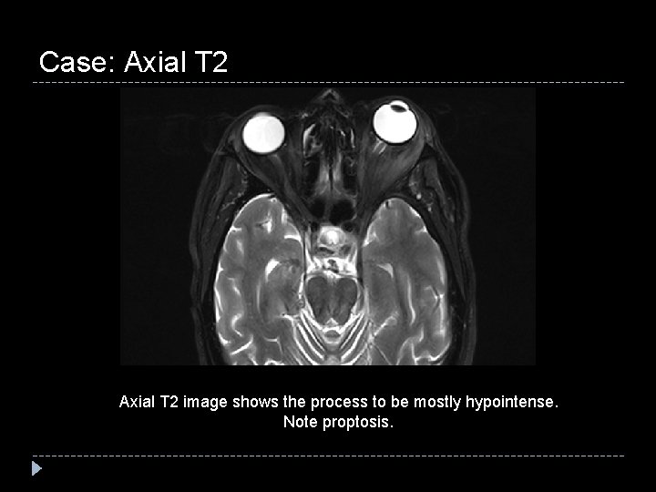 Case: Axial T 2 image shows the process to be mostly hypointense. Note proptosis.