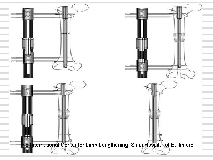 The International Center for Limb Lengthening, Sinai Hospital of Baltimore 29 