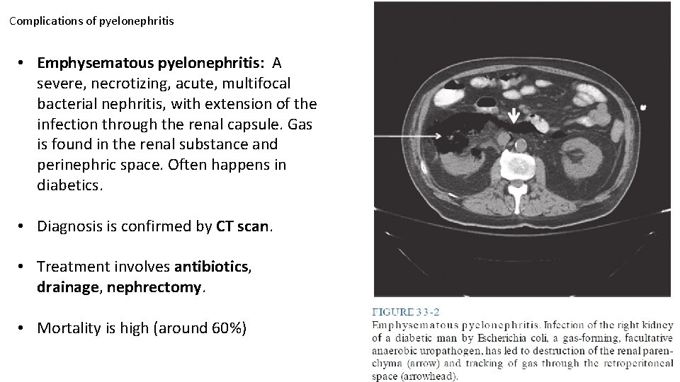 Complications of pyelonephritis • Emphysematous pyelonephritis: A severe, necrotizing, acute, multifocal bacterial nephritis, with Complications of pyelonephritis • Emphysematous pyelonephritis: A severe, necrotizing, acute, multifocal bacterial nephritis, with