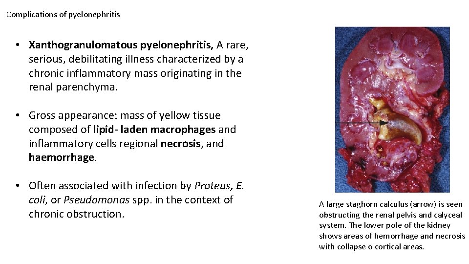Complications of pyelonephritis • Xanthogranulomatous pyelonephritis, A rare, serious, debilitating illness characterized by a Complications of pyelonephritis • Xanthogranulomatous pyelonephritis, A rare, serious, debilitating illness characterized by a