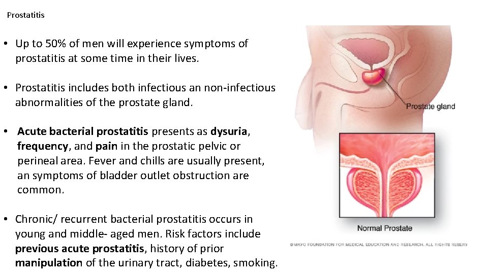 Prostatitis • Up to 50% of men will experience symptoms of prostatitis at some Prostatitis • Up to 50% of men will experience symptoms of prostatitis at some