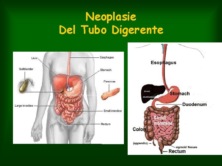 Neoplasie Del Tubo Digerente 