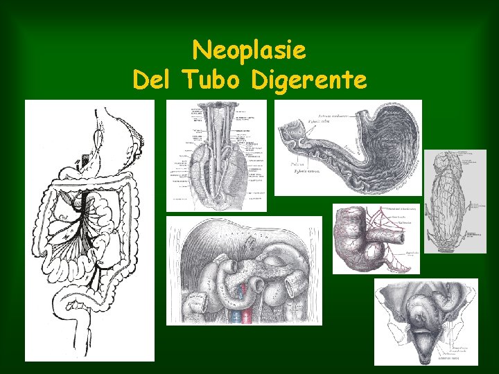 Neoplasie Del Tubo Digerente 
