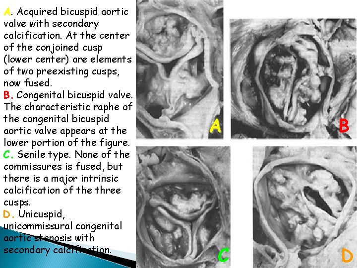 A. Acquired bicuspid aortic valve with secondary calcification. At the center of the conjoined