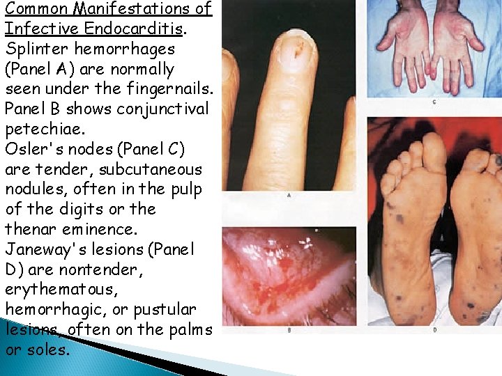 Common Manifestations of Infective Endocarditis. Splinter hemorrhages (Panel A) are normally seen under the