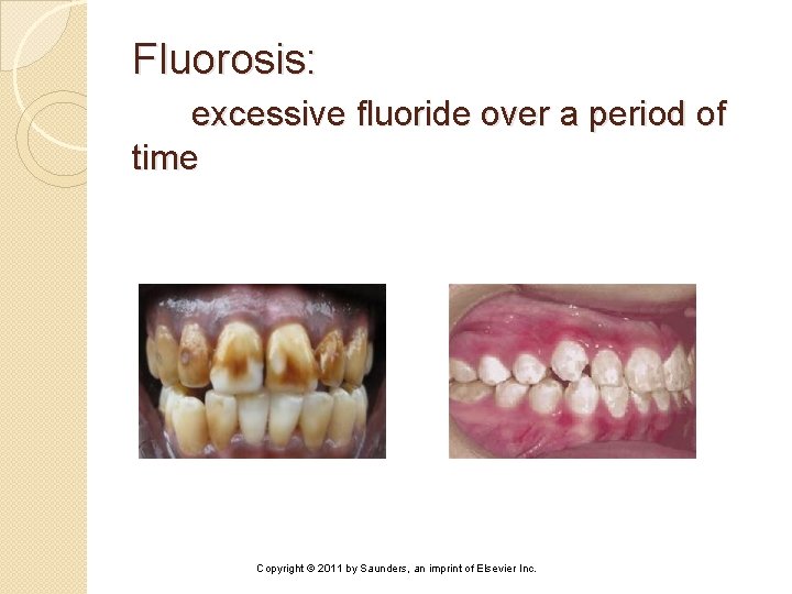 Fluorosis: excessive fluoride over a period of time Copyright © 2011 by Saunders, an