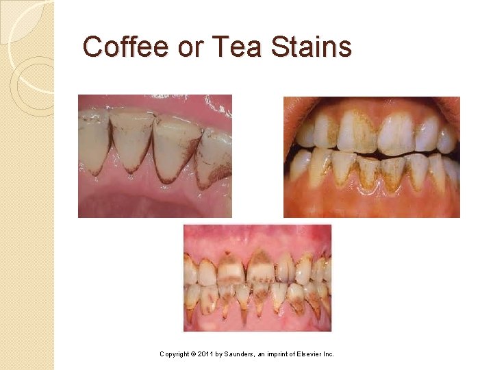 Coffee or Tea Stains Copyright © 2011 by Saunders, an imprint of Elsevier Inc.