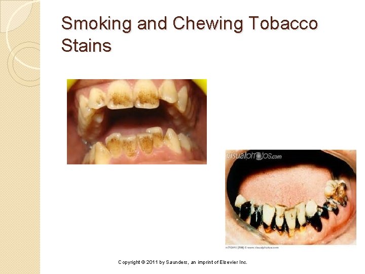 Smoking and Chewing Tobacco Stains Copyright © 2011 by Saunders, an imprint of Elsevier