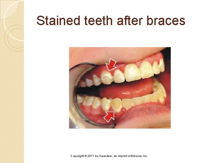 Stained teeth after braces Copyright © 2011 by Saunders, an imprint of Elsevier Inc.
