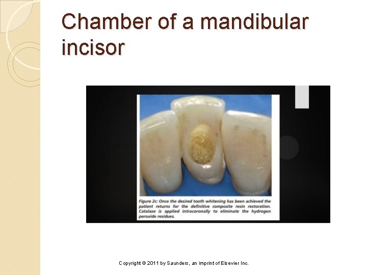 Chamber of a mandibular incisor Copyright © 2011 by Saunders, an imprint of Elsevier