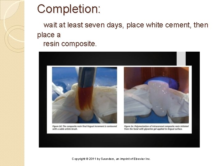 Completion: wait at least seven days, place white cement, then place a resin composite.