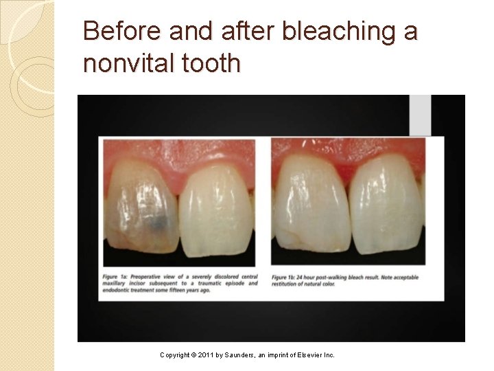 Before and after bleaching a nonvital tooth Copyright © 2011 by Saunders, an imprint