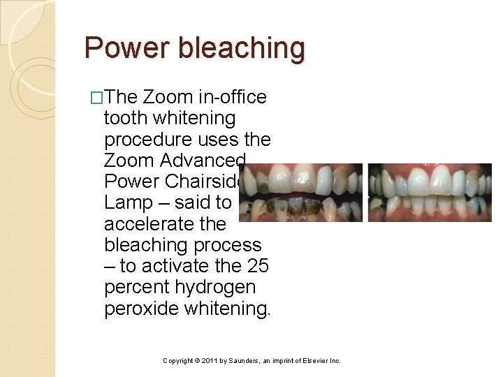 Power bleaching �The Zoom in-office tooth whitening procedure uses the Zoom Advanced Power Chairside