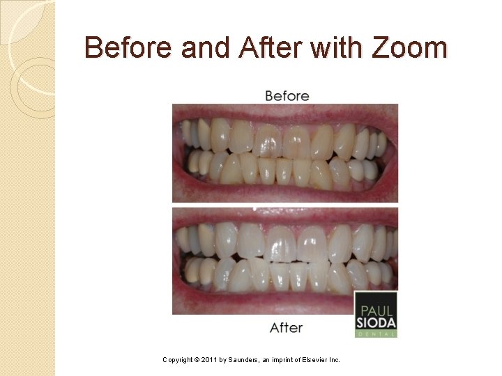 Before and After with Zoom Copyright © 2011 by Saunders, an imprint of Elsevier