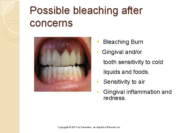 Possible bleaching after concerns • Bleaching Burn • Gingival and/or tooth sensitivity to cold