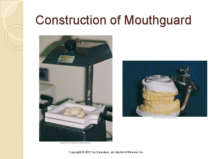 Construction of Mouthguard Copyright © 2011 by Saunders, an imprint of Elsevier Inc. 