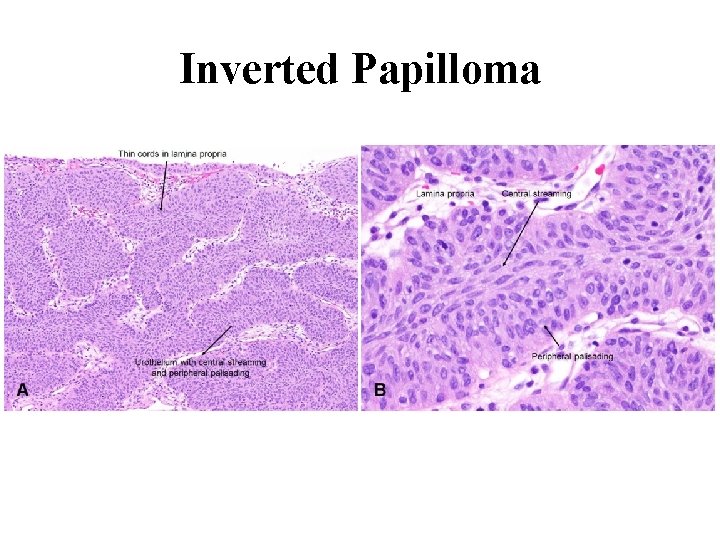 Inverted Papilloma 