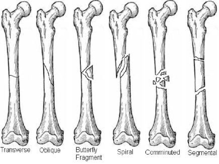 Principles of fractures Dr Mohammad Abu Hilal Ass