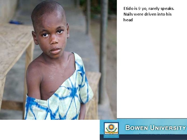 Etido is 9 yo, rarely speaks. Nails were driven into his head 