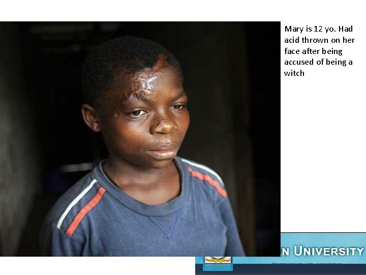 Mary is 12 yo. Had acid thrown on her face after being accused of