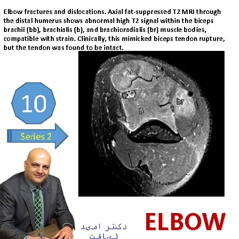 Elbow fractures and dislocations. Axial fat-suppressed T 2 MRI through the distal humerus shows