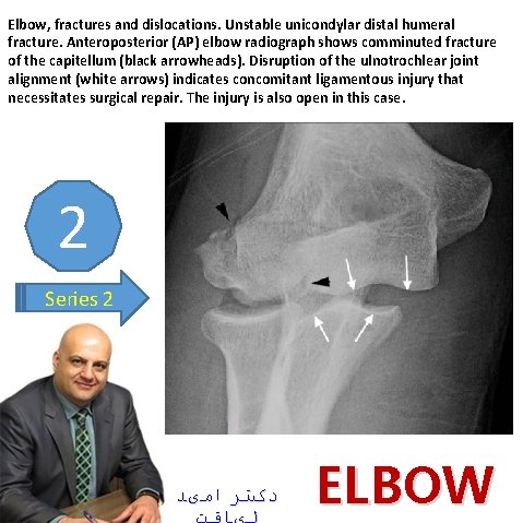 Elbow, fractures and dislocations. Unstable unicondylar distal humeral fracture. Anteroposterior (AP) elbow radiograph shows