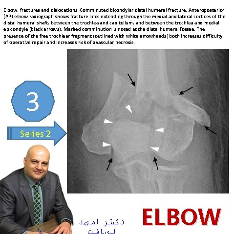 Elbow, fractures and dislocations. Comminuted bicondylar distal humeral fracture. Anteroposterior (AP) elbow radiograph shows