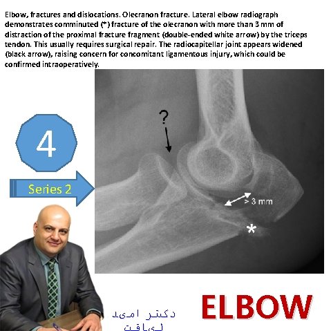 Elbow, fractures and dislocations. Olecranon fracture. Lateral elbow radiograph demonstrates comminuted (*) fracture of