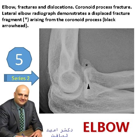 Elbow, fractures and dislocations. Coronoid process fracture. Lateral elbow radiograph demonstrates a displaced fracture