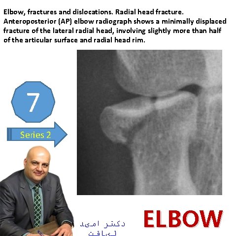 Elbow, fractures and dislocations. Radial head fracture. Anteroposterior (AP) elbow radiograph shows a minimally