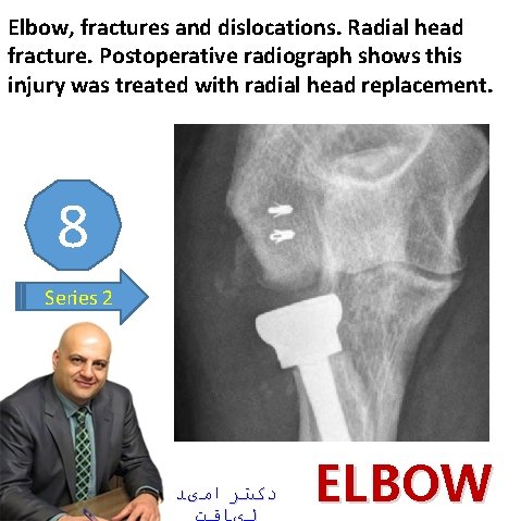 Elbow, fractures and dislocations. Radial head fracture. Postoperative radiograph shows this injury was treated
